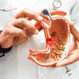Tratamiento del cáncer de colon en etapa 4 en México