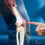 El mejor lugar del mundo para hacerse un reemplazo de rodilla