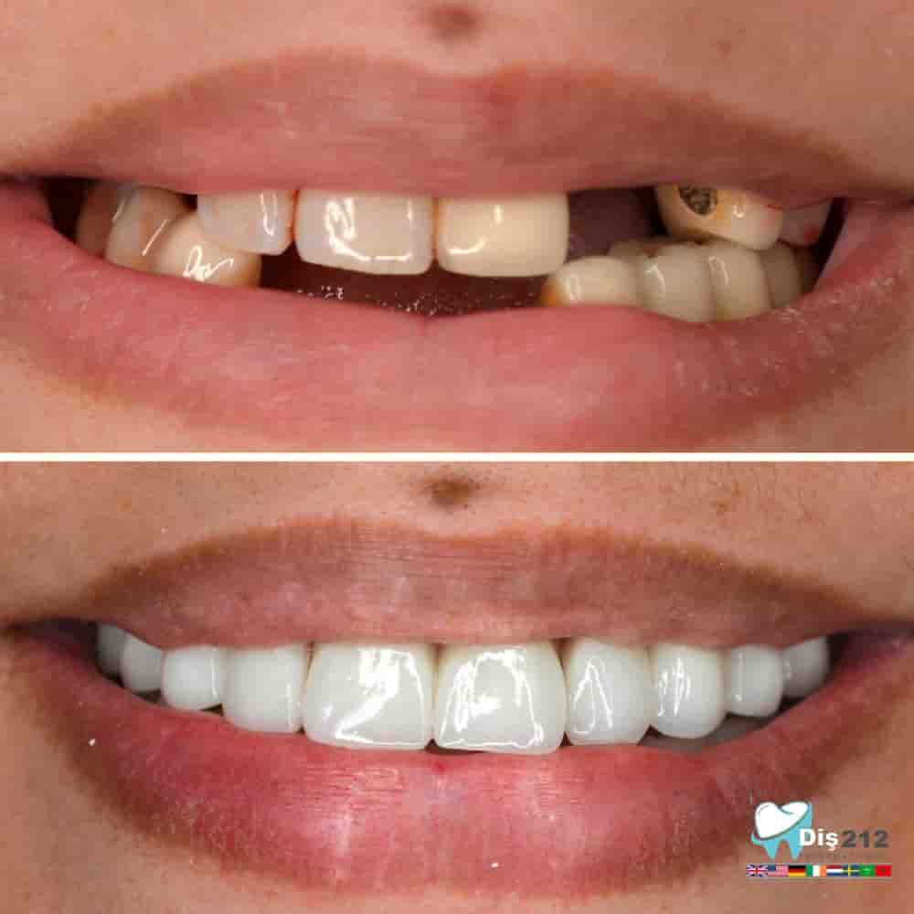 Dis 212 - Dental Aesthetics Facility en Istanbul, Turkey Reseñas de pacientes reales Slider image 2