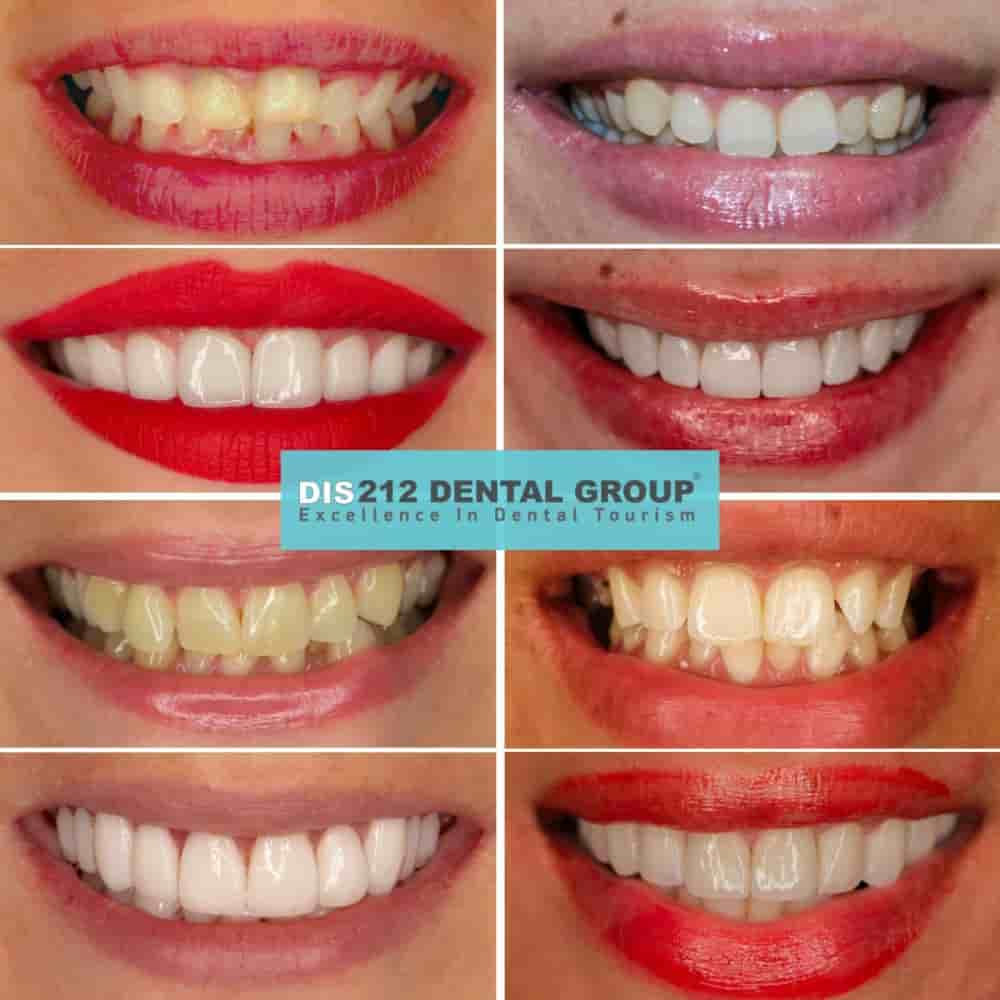 Dis 212 - Dental Aesthetics Facility en Istanbul, Turkey Reseñas de pacientes reales Slider image 3