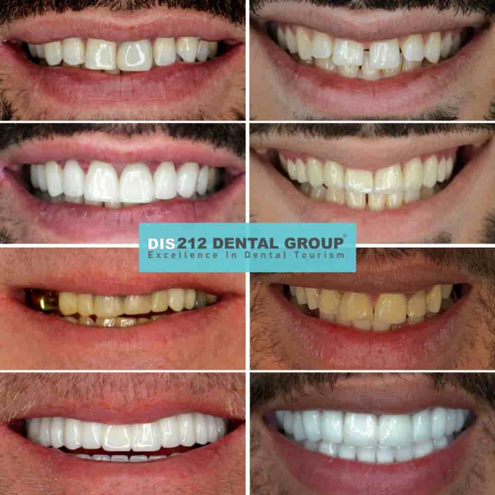 Dis 212 - Dental Aesthetics Facility en Istanbul, Turkey Reseñas de pacientes reales Slider image 4