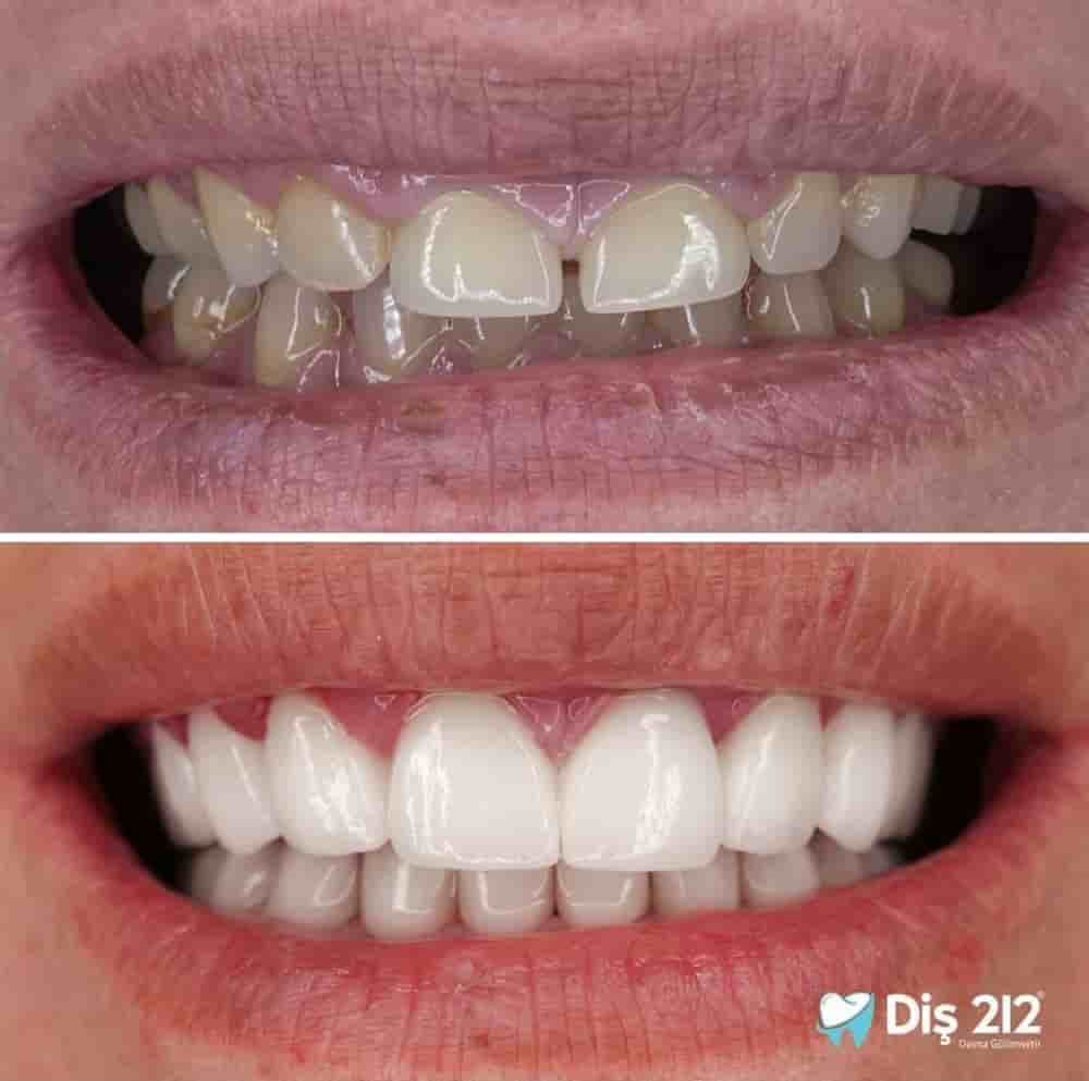Dis 212 - Dental Aesthetics Facility en Istanbul, Turkey Reseñas de pacientes reales Slider image 5