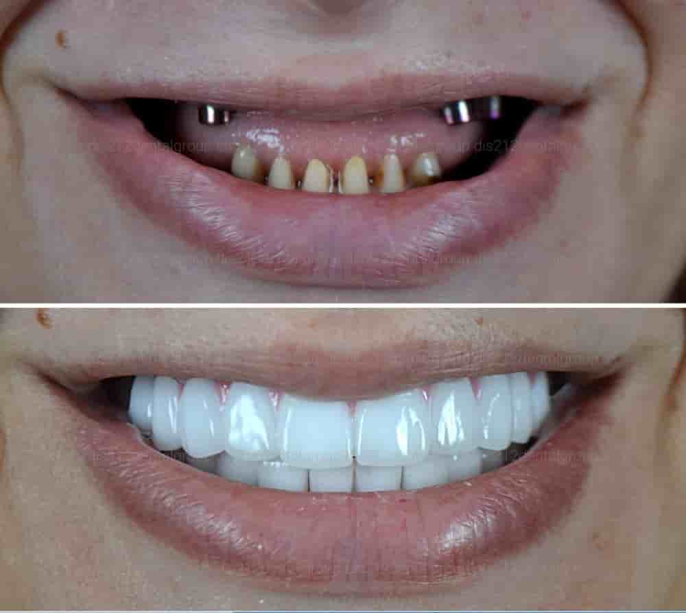 Dis 212 - Dental Aesthetics Facility en Istanbul, Turkey Reseñas de pacientes reales Slider image 6