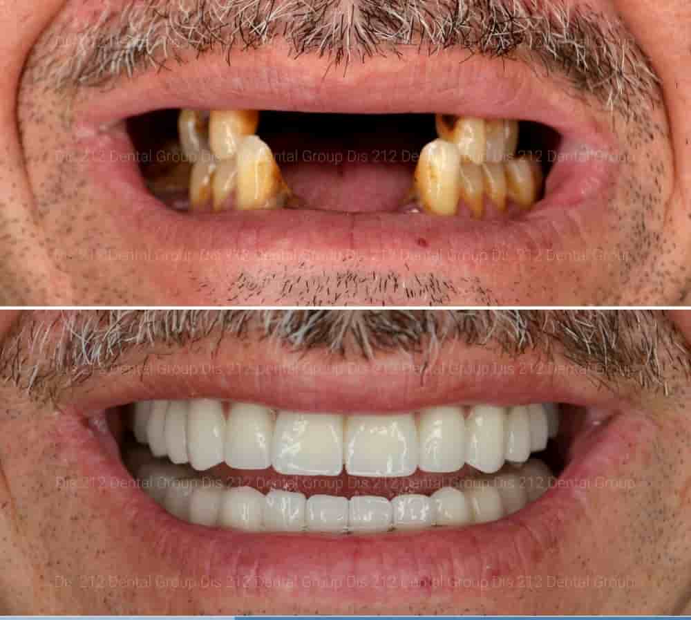 Dis 212 - Dental Aesthetics Facility en Istanbul, Turkey Reseñas de pacientes reales Slider image 7