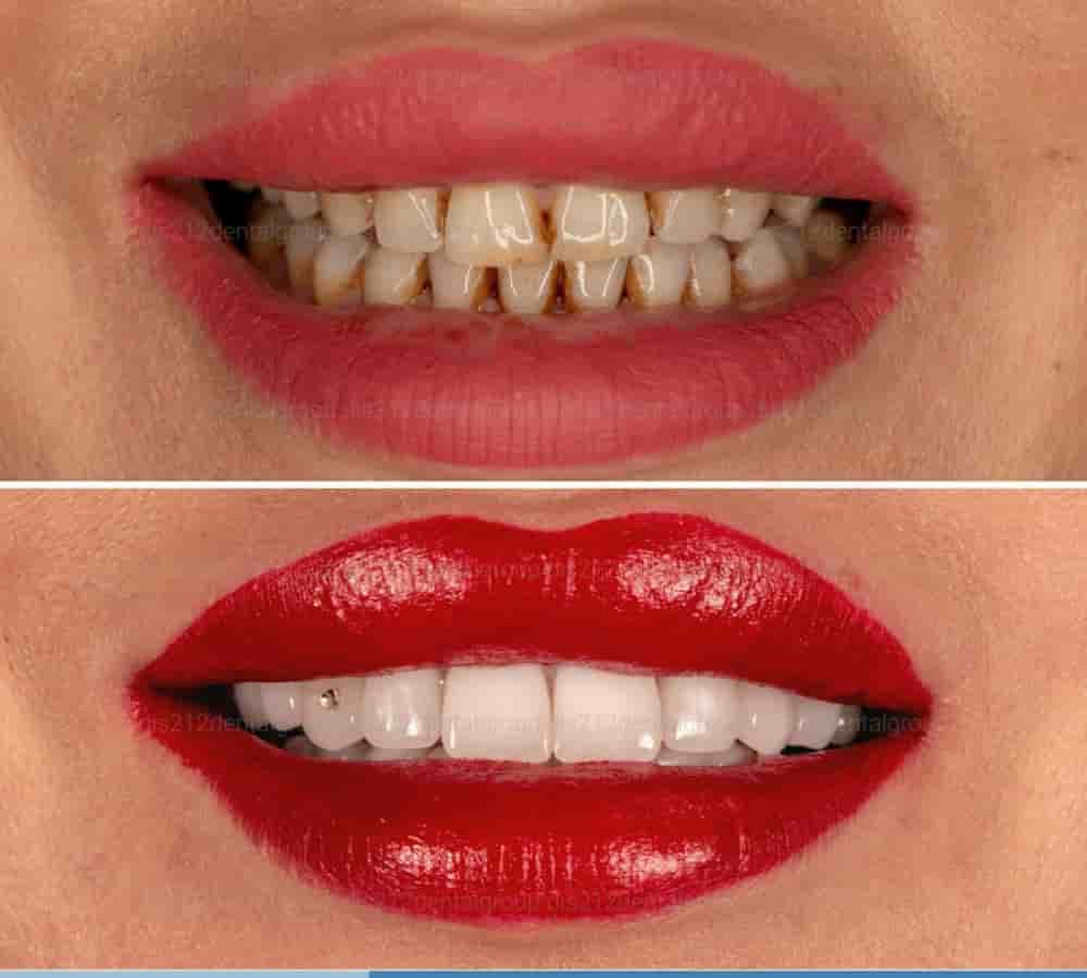 Dis 212 - Dental Aesthetics Facility en Istanbul, Turkey Reseñas de pacientes reales Slider image 9