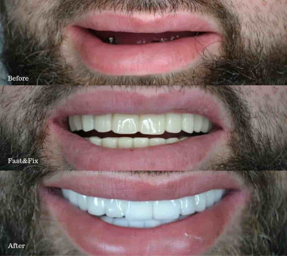 Dis 212 - Dental Aesthetics Facility en Istanbul, Turkey Reseñas de pacientes reales Slider image 10