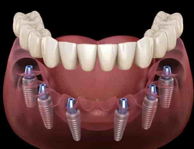 DG Dental - Dr. Diana Gastelum Reviews in Mexicali, Mexico Slider image 7