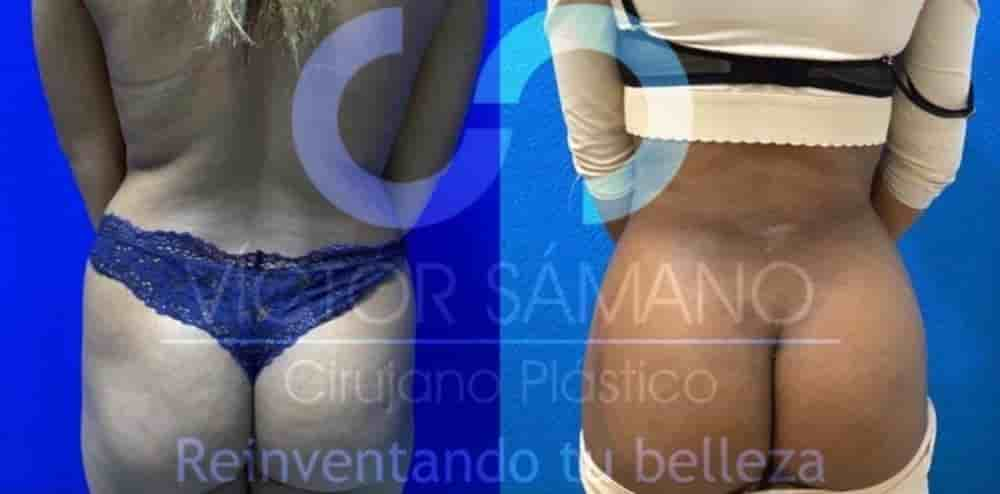 Dr Victor Samano Plastic Surgery Cancun en Cancun,Playa Del Carmen, Mexico Reseñas de pacientes reales Slider image 9