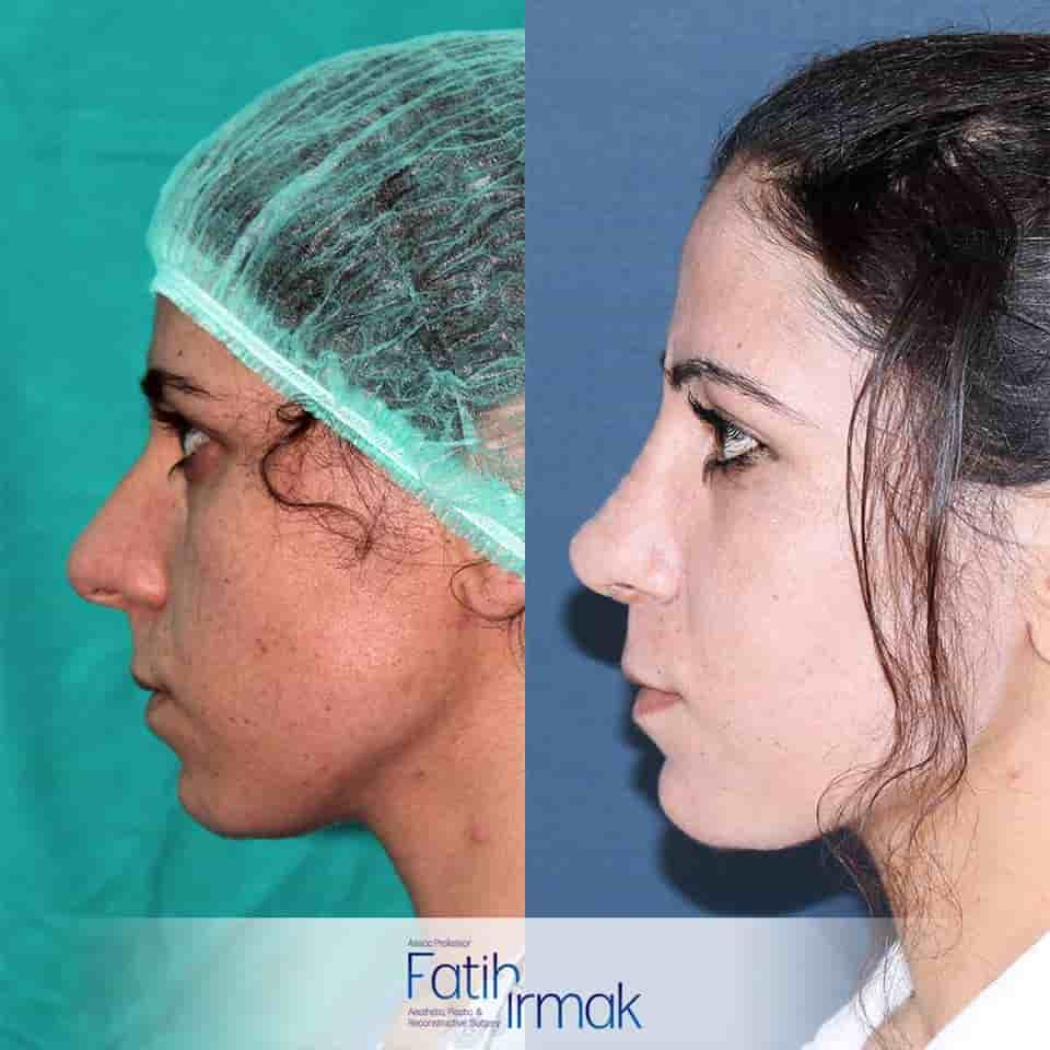 Assoc. Prof. Fatih Irmak Aesthetic and Plastic Surgery Clinic en Istanbul, Turkey Reseñas de pacientes reales Slider image 1