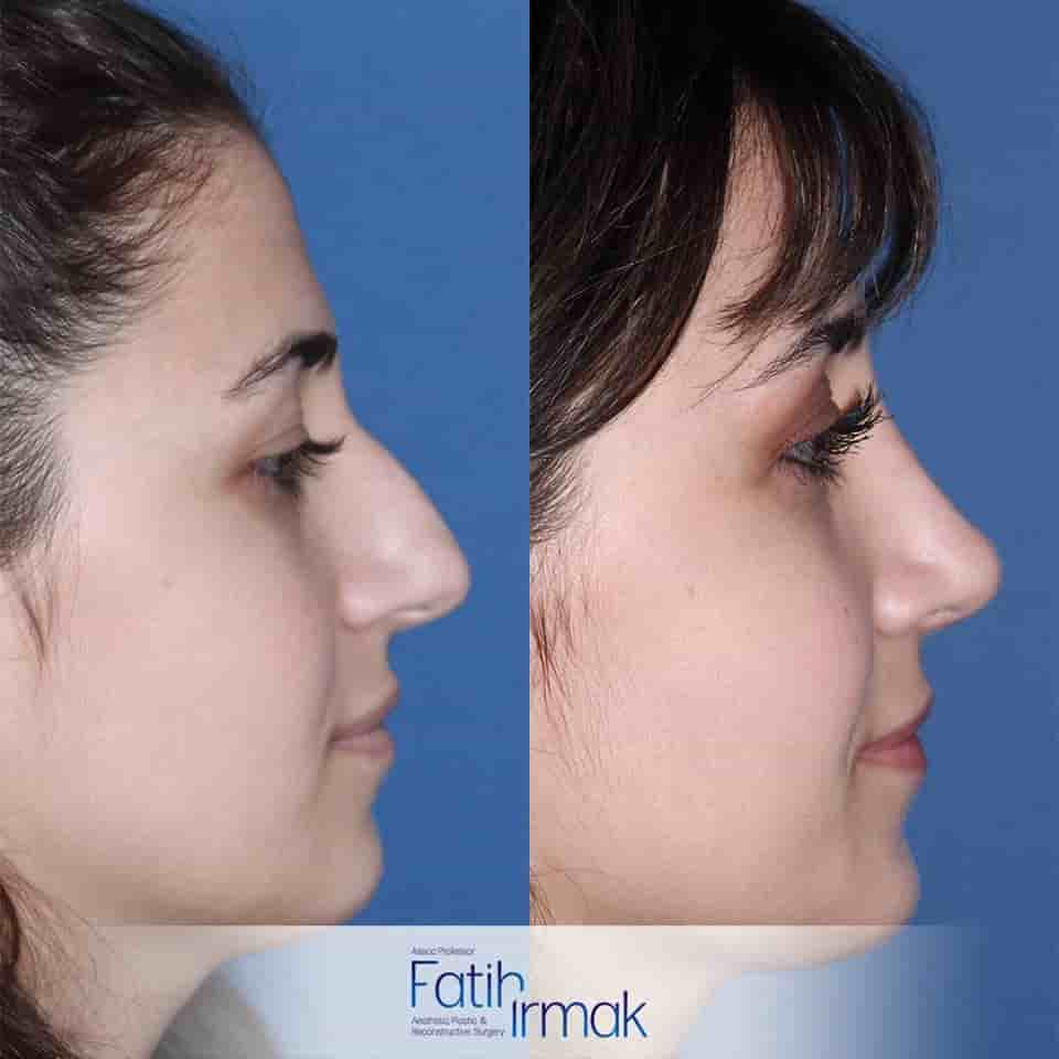 Assoc. Prof. Fatih Irmak Aesthetic and Plastic Surgery Clinic en Istanbul, Turkey Reseñas de pacientes reales Slider image 3