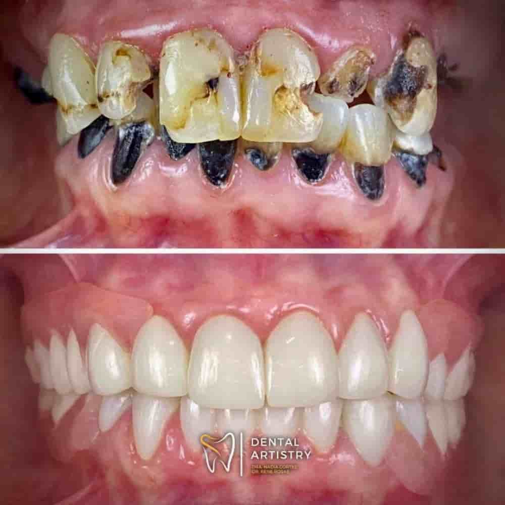 Dental Artistry Dental Center en Nuevo Progreso, Mexico Reseñas de pacientes reales Slider image 4