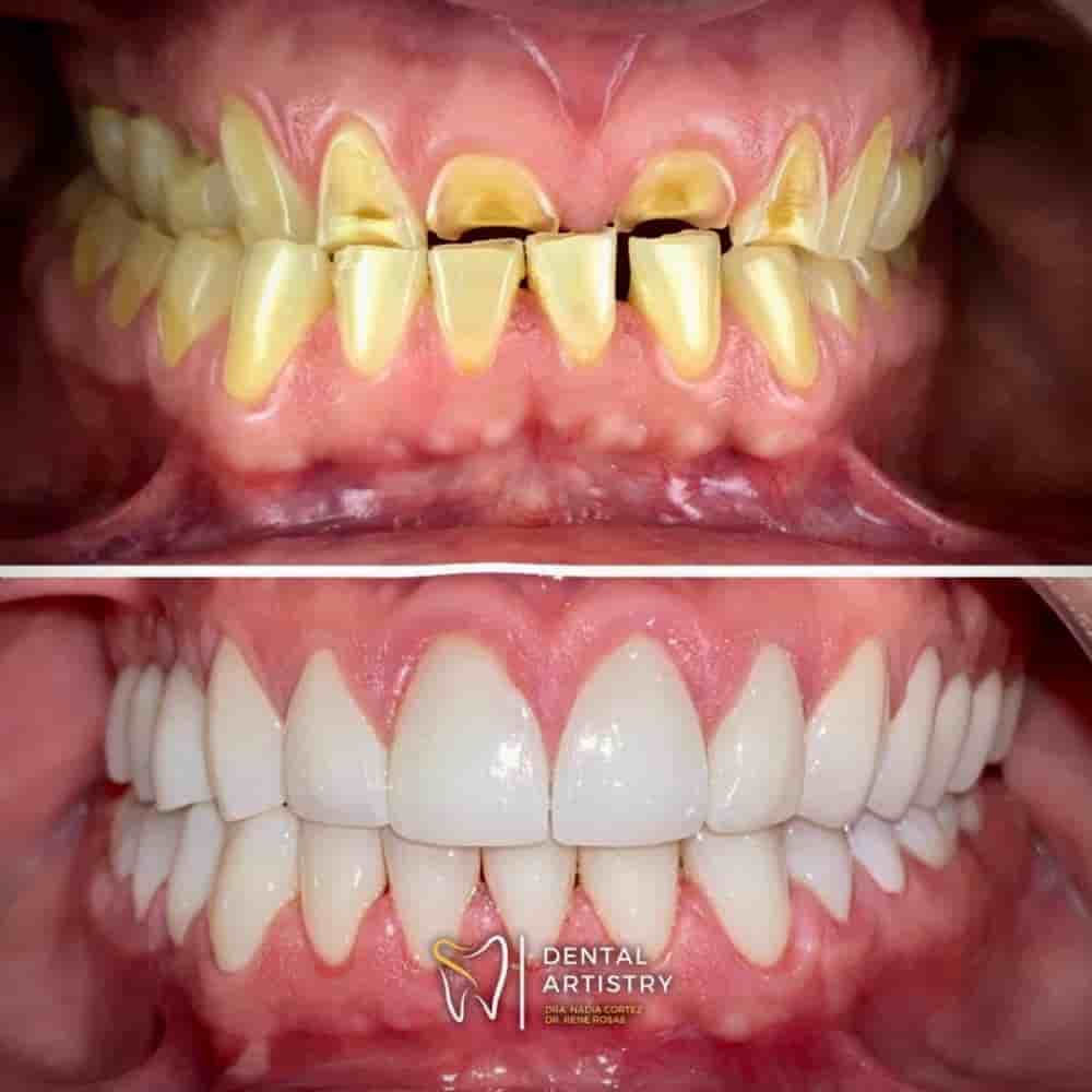 Dental Artistry Dental Center en Nuevo Progreso, Mexico Reseñas de pacientes reales Slider image 7