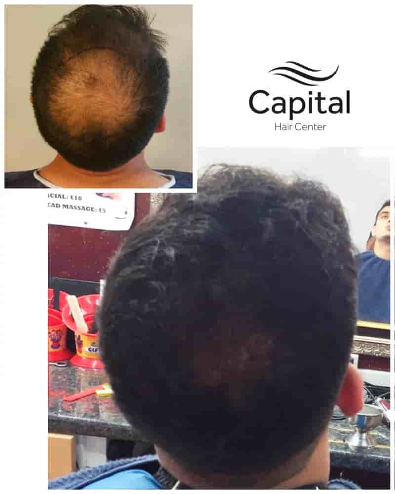 Capital Hair Center Reviews in Istanbul, Turkey by Hair Transplant Patients Slider image 9