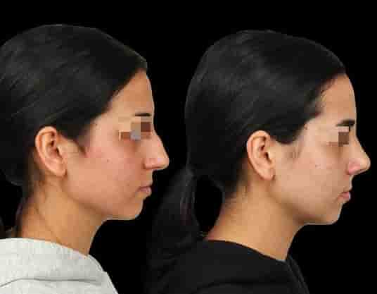 The Nose Aesthetic Clinic Reviews in Istanbul, Turkey Slider image 4