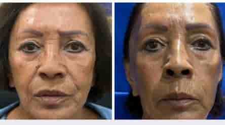 Aesthetic and Oncologic Face, Head and Neck Clinic and OR en Tijuana, Mexico Reseñas de pacientes reales Slider image 3