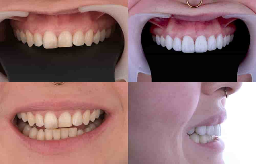 Dentleon Polyclinics en Izmir, Turkey Reseñas de pacientes reales Slider image 4