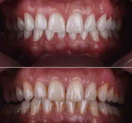 Smile Zone Clinic en Ankara, Turkey Reseñas de pacientes reales Slider image 4