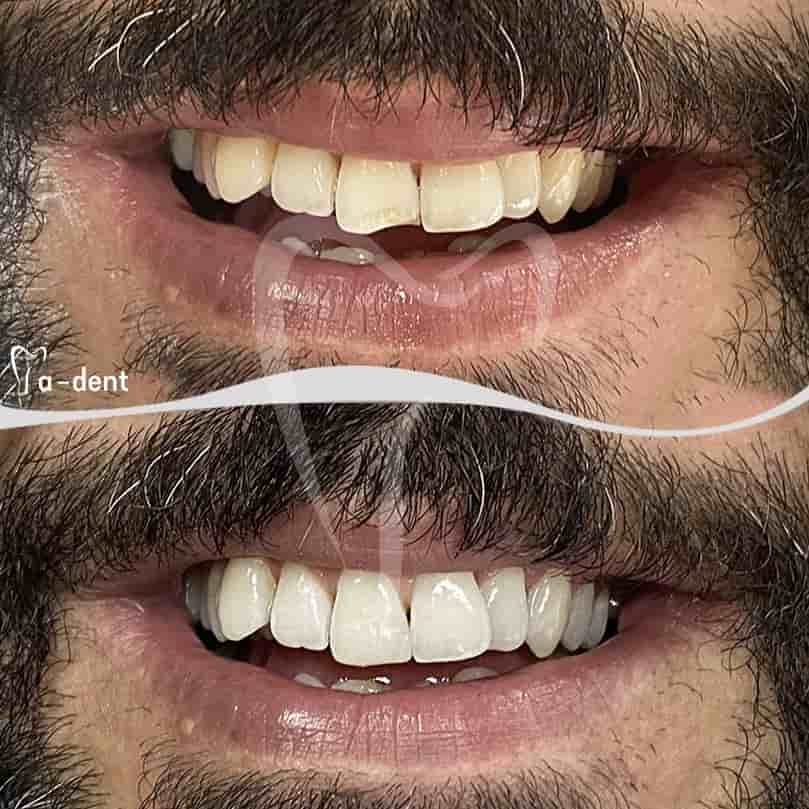 A-dent Dental Clinic en Antalya, Turkey Reseñas de pacientes reales Slider image 2