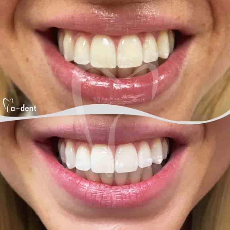 A-dent Dental Clinic en Antalya, Turkey Reseñas de pacientes reales Slider image 4