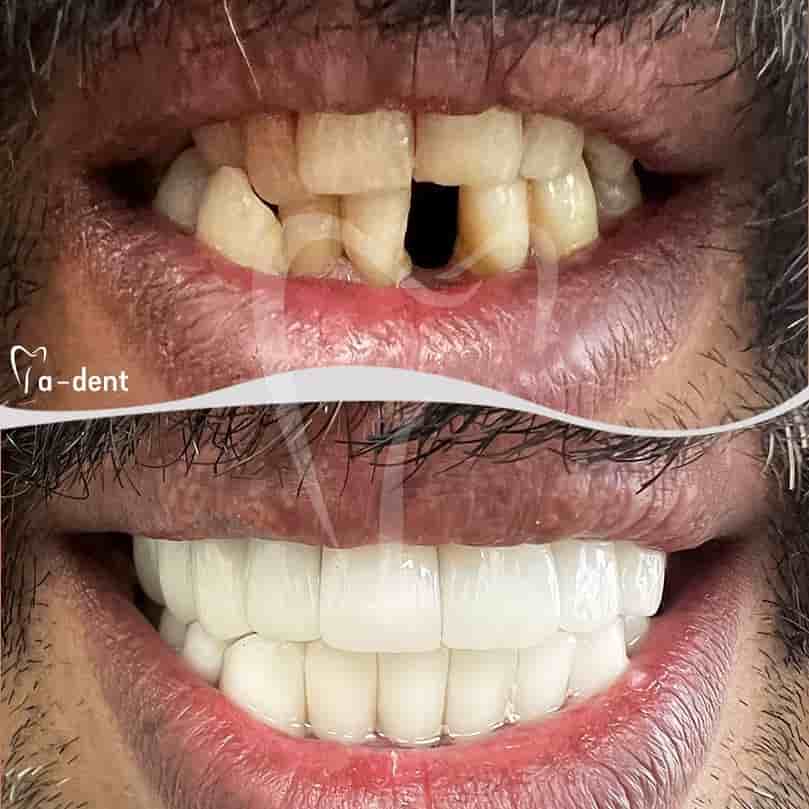 A-dent Dental Clinic en Antalya, Turkey Reseñas de pacientes reales Slider image 7