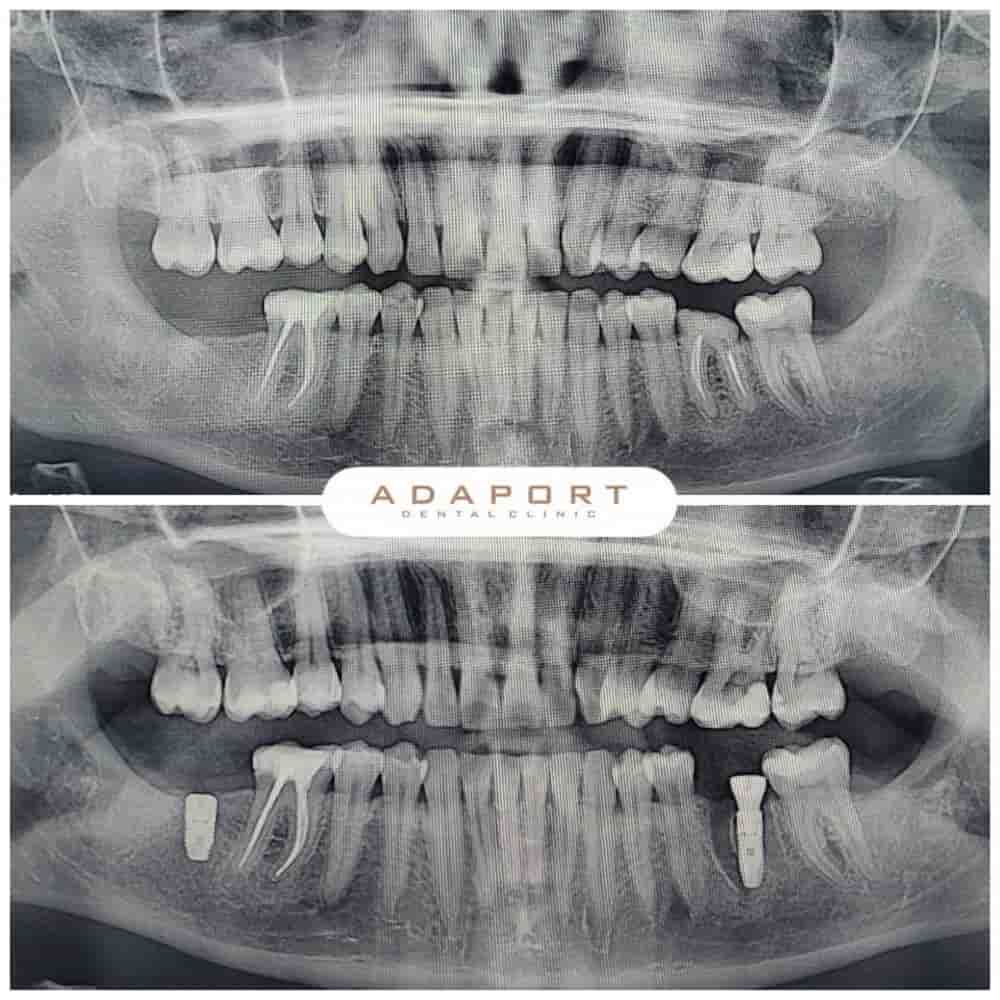 Adaport Dental Clinic en Izmir, Turkey Reseñas de pacientes reales Slider image 2