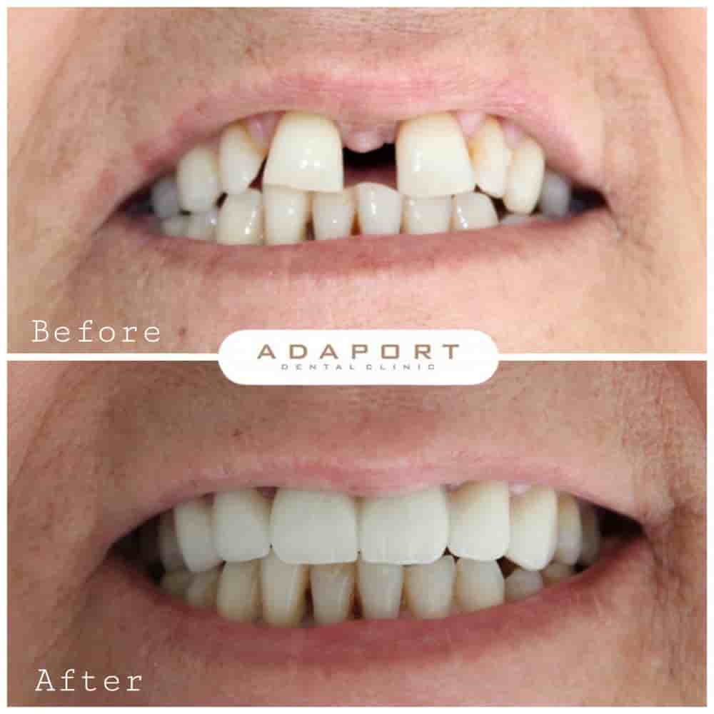 Adaport Dental Clinic en Izmir, Turkey Reseñas de pacientes reales Slider image 4