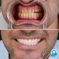 Turkiye Dental en , Turkey Reseñas de pacientes reales Slider image 3