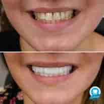 Turkiye Dental en , Turkey Reseñas de pacientes reales Slider image 4