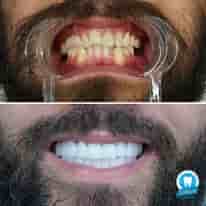 Turkiye Dental en , Turkey Reseñas de pacientes reales Slider image 5