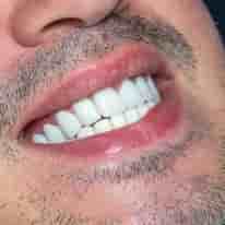 Turkiye Dental en , Turkey Reseñas de pacientes reales Slider image 8