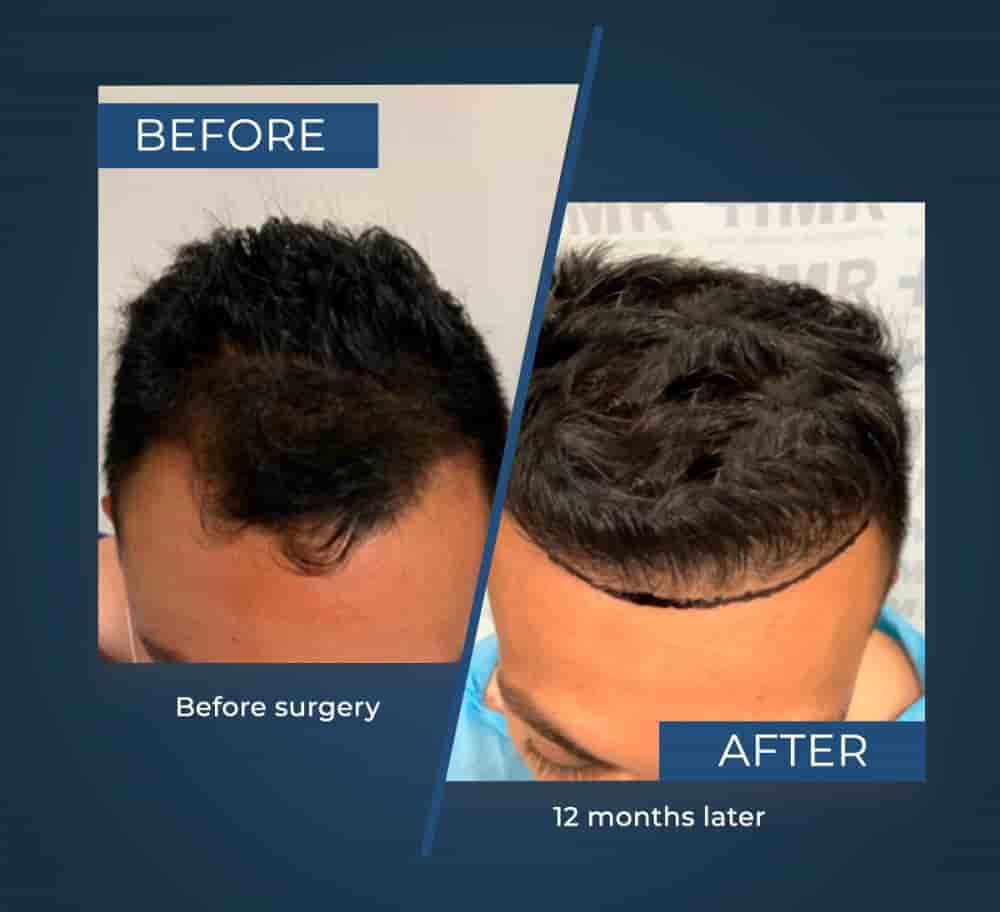 Hair Medical Restoration (HMR) in Tijuana, Mexico Reviews from Real Patients Slider image 4