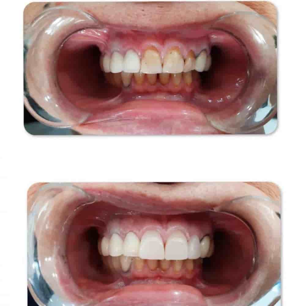 Prestij Dental Clinic en Antalya, Turkey Reseñas de pacientes reales Slider image 7