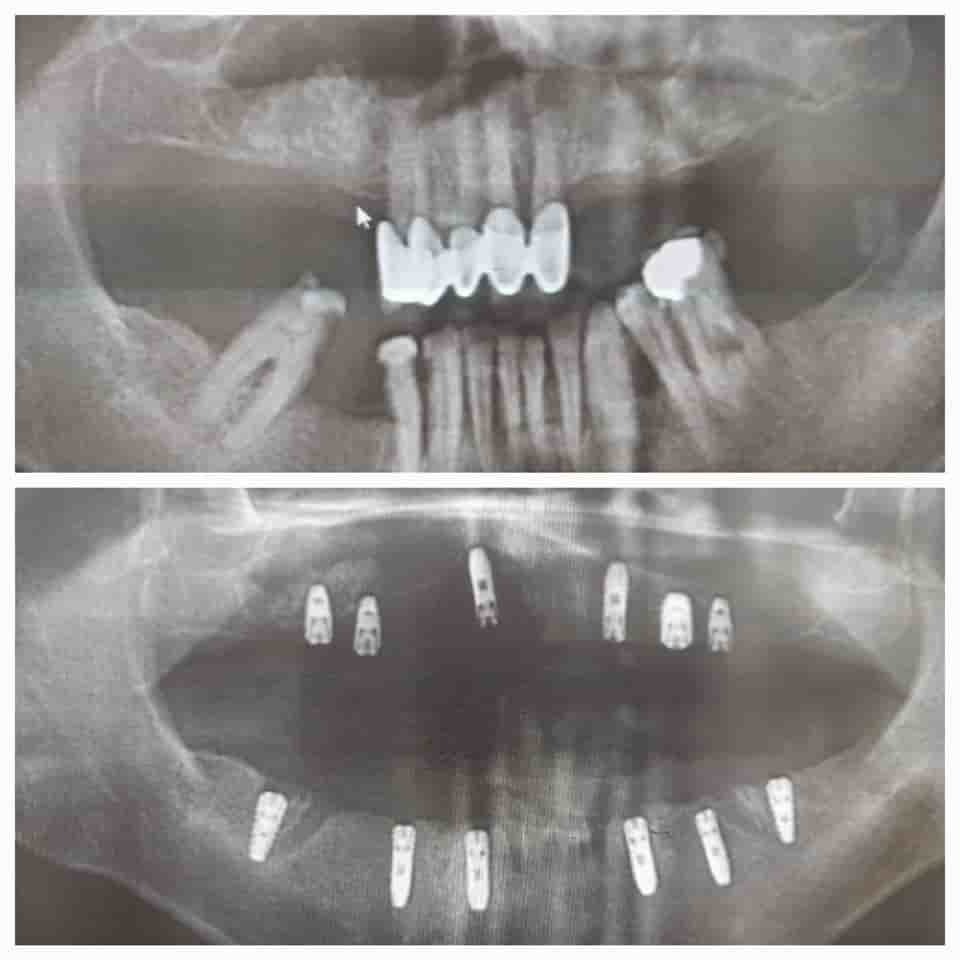 Prestij Dental Clinic en Antalya, Turkey Reseñas de pacientes reales Slider image 8