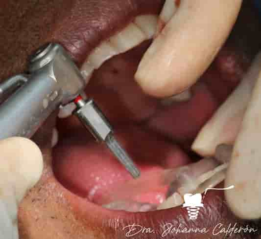 Dental Implants in Colombia Dr Johanna Calderon - Aesthetic and Specialized Dentistry in Medellin,Bogota,Cali,Barranquilla,Cartagena,Ibague, Colombia Reviews from Real Patients Slider image 2