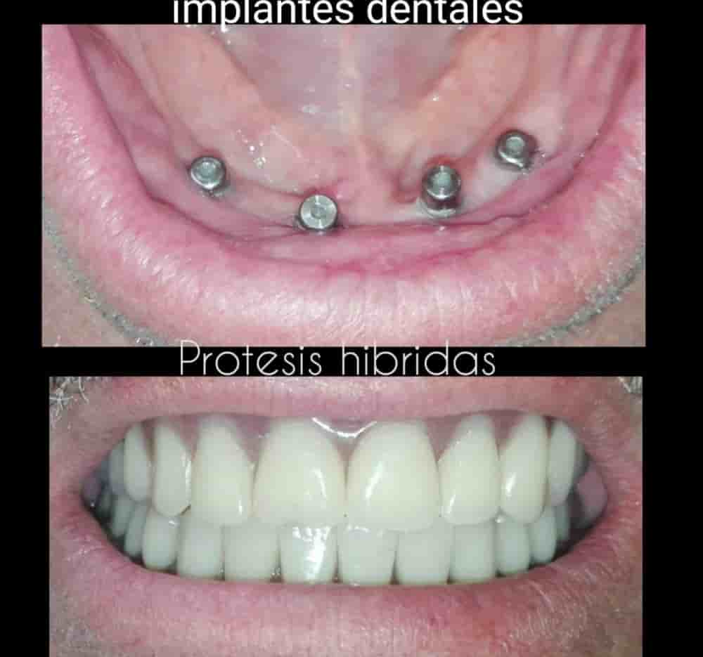 Dental Implants in Colombia Dr Johanna Calderon - Aesthetic and Specialized Dentistry in Medellin,Bogota,Cali,Barranquilla,Cartagena,Ibague, Colombia Reviews from Real Patients Slider image 10