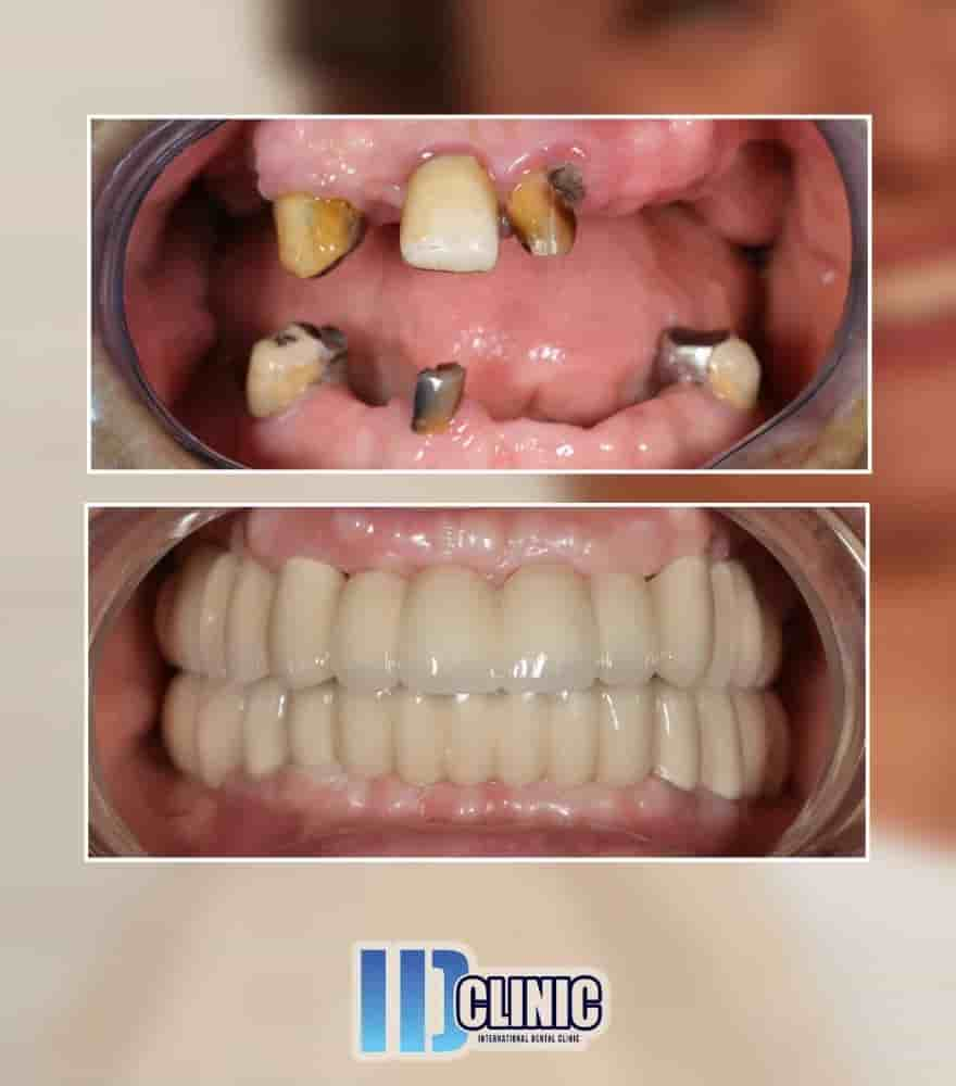 IDC International Dental Clinic in Antalya, Turkey Reviews from Real Patients Slider image 2