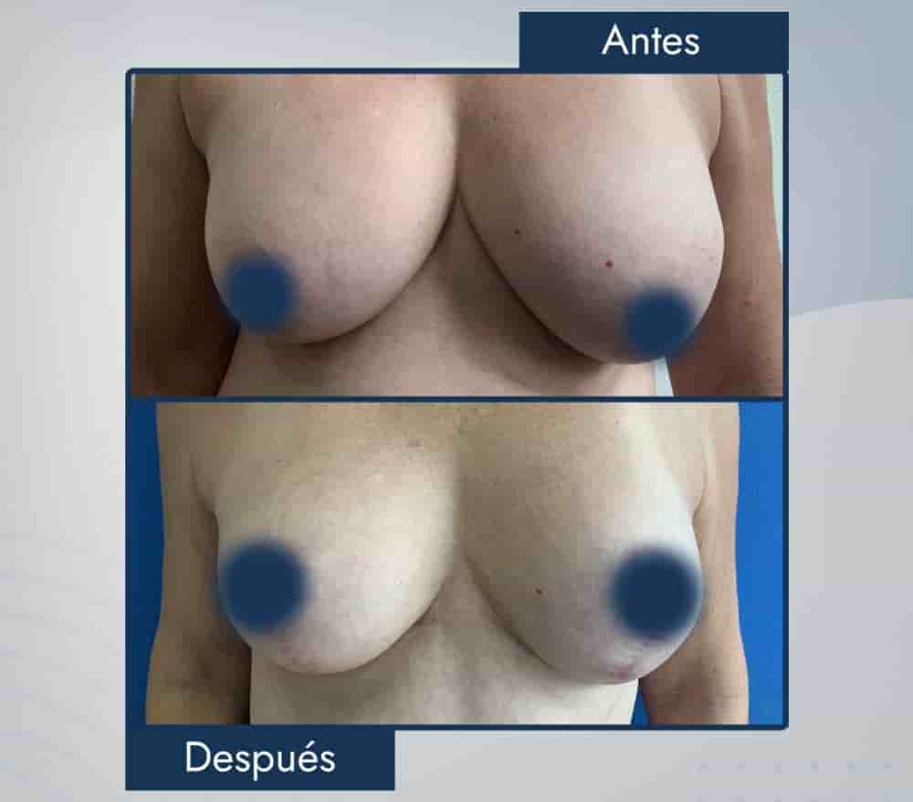 Dr. Jose E. Telich - Plastic Surgeon in Mexico City, Mexico Reviews from Real Patients Slider image 6