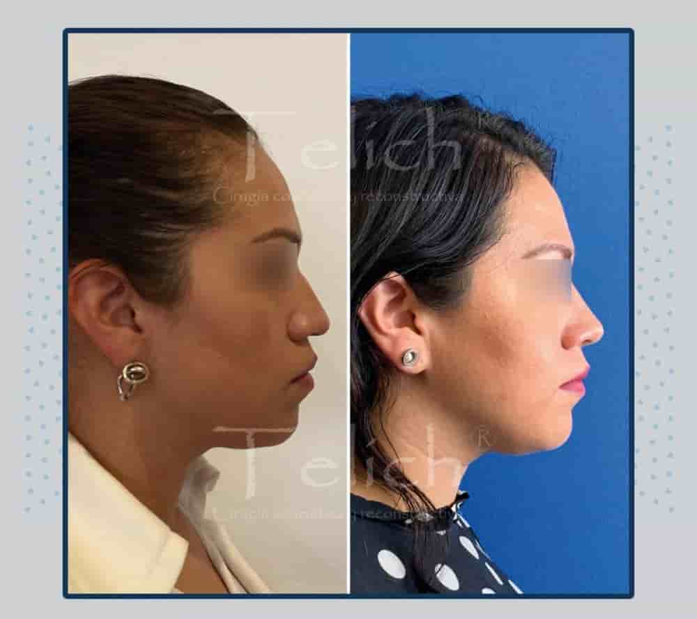 Dr. Jose E. Telich - Plastic Surgeon in Mexico City, Mexico Reviews from Real Patients Slider image 8