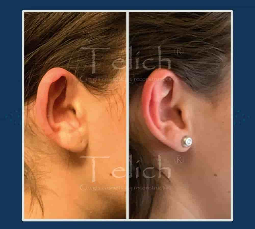 Dr. Jose E. Telich - Plastic Surgeon in Mexico City, Mexico Reviews from Real Patients Slider image 9