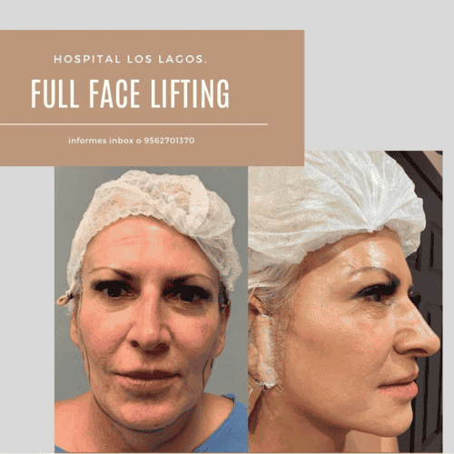 Paquete de lifting facial en Reynosa, México por Hospital Los Lagos