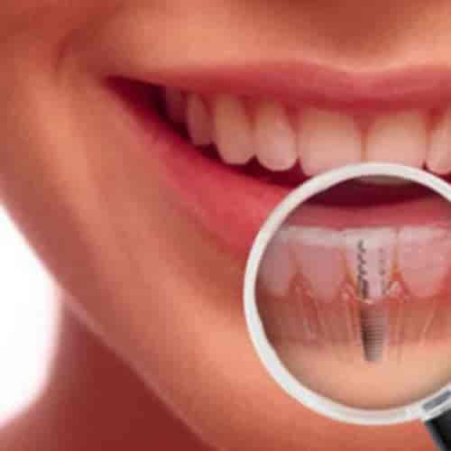 Costo del paquete de implantes dentales en San José, Costa Rica por American Dental Care