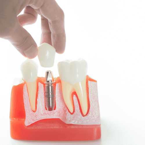 Paquete de corona dental Cerec de Dental Brush Tijuana, México