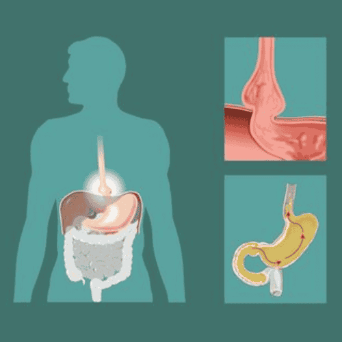 Paquete de bajo costo para reparación de hernia hiatal en Mérida, México