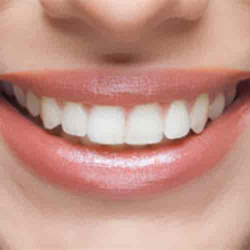 Paquete de implantes dentales All on 4 en Cancún, México con YeahSmile