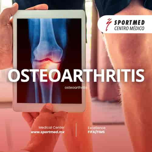 Paquete de Terapia con Células Madre para Osteoartritis en Guadalajara, México por SPORTMED