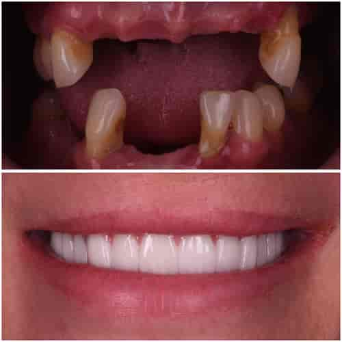 Paquete de implantes dentales All on 4 con prótesis híbrida de titanio en Clinic Prime Istanbul, Estambul, Turquía