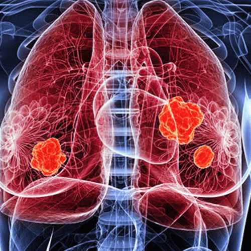 Vacunas cubanas terapéuticas contra el cáncer de pulmón