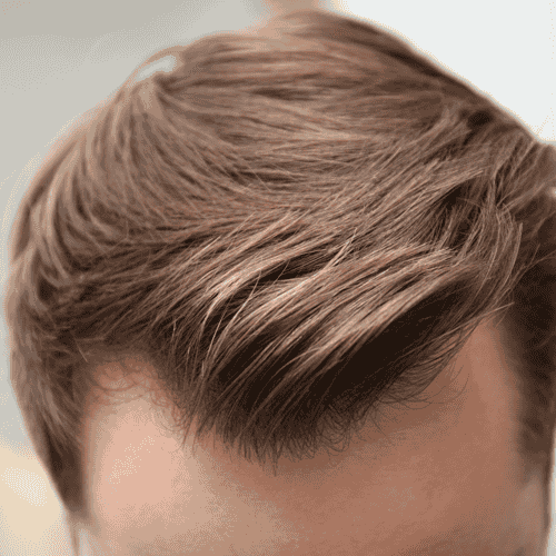 Trasplante de cabello FUE en Bellus Clinic: recupera tu cabello con Bellus Clinic