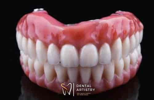 Paquete de implantes dentales All-on-6 con todo incluido en Nuevo Progreso, México, de Dental Artistry
