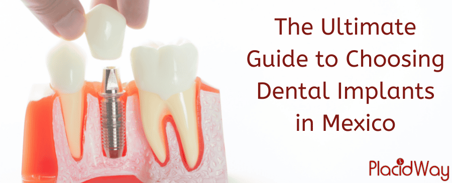 Implantes dentales en México